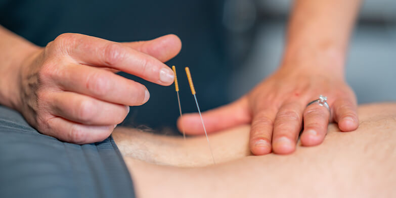 Dry Needling SMC Physicians Physical Therapy
