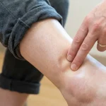 Why Your Feet and Ankles May Swell in the Summer